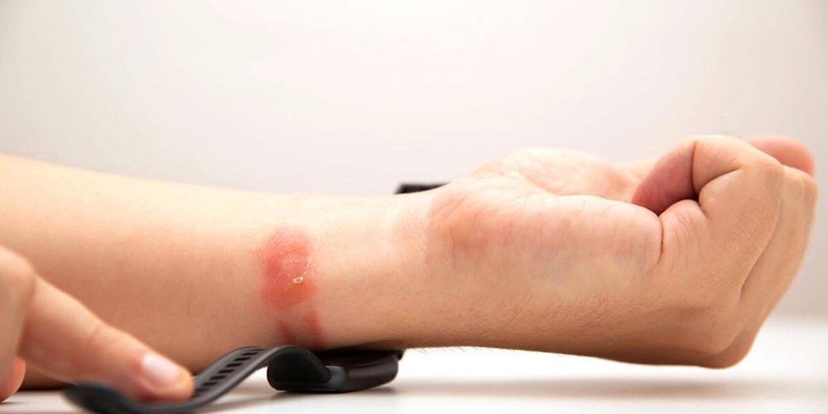Tại Sao Đeo Đồng Hồ Thể Thao Lại Gây Dị Ứng? Nguyên Nhân Và Giải Pháp